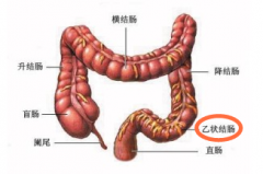 乙状结肠炎怎么治？