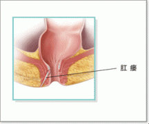 肛瘘不治疗会怎么样