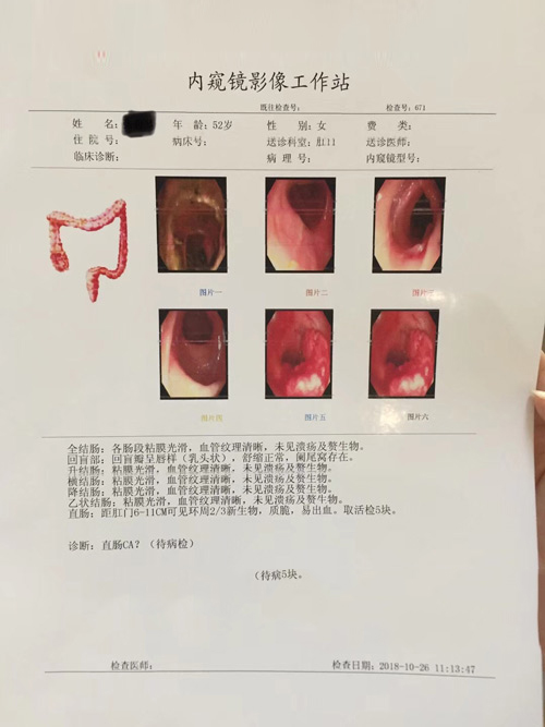 直肠肿瘤报告检查单